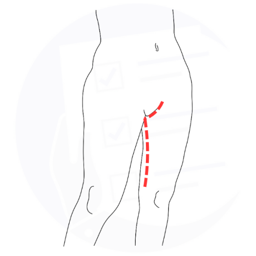 Lifting delle cosce con incisione inguinale prolungata sulla coscia Lifting delle cosce con incisione inguinale prolungata sulla coscia